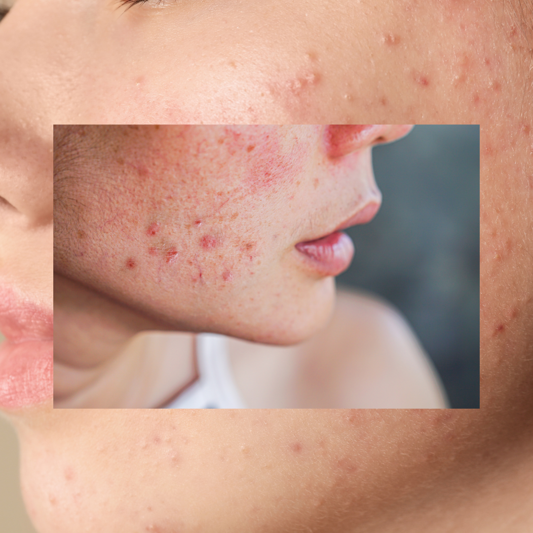 Understanding Acne Grades 1-4: Your Complete Guide for Acne Awareness Month