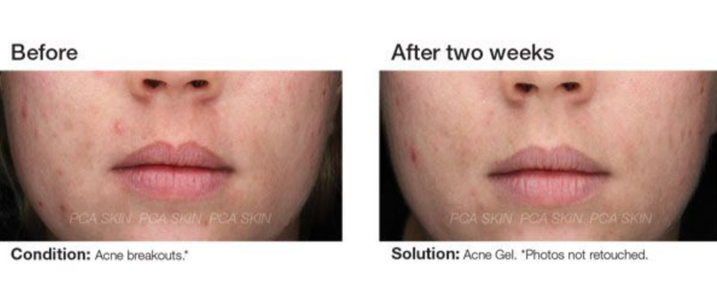 Acne Gel Advanced Treatment