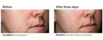 Acne Gel Advanced Treatment