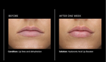 Hyaluronic Acid Lip Booster